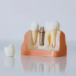 Implanty zębów w Turcji