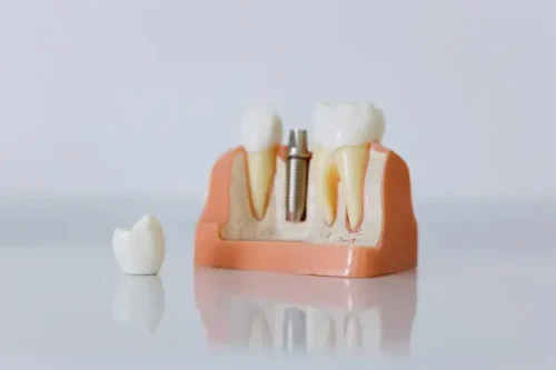 Implanty zębów w Turcji: Idealne rozwiązanie dla zdrowego uśmiechu